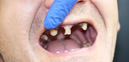 Failing remaining teeth needing full clearance